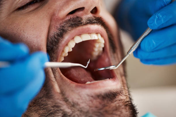 Best Knocked-Out Tooth (Avulsed Tooth) Treatment in Santa Fe, NM